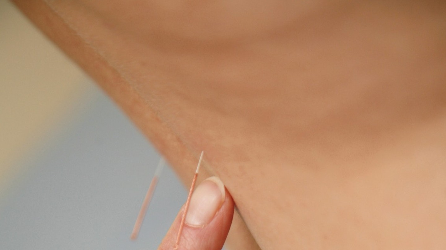 Could Acupuncture Help You Have A Better Labour?
