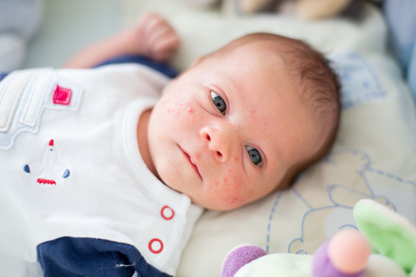 Baby with milia and acne looking at the camera