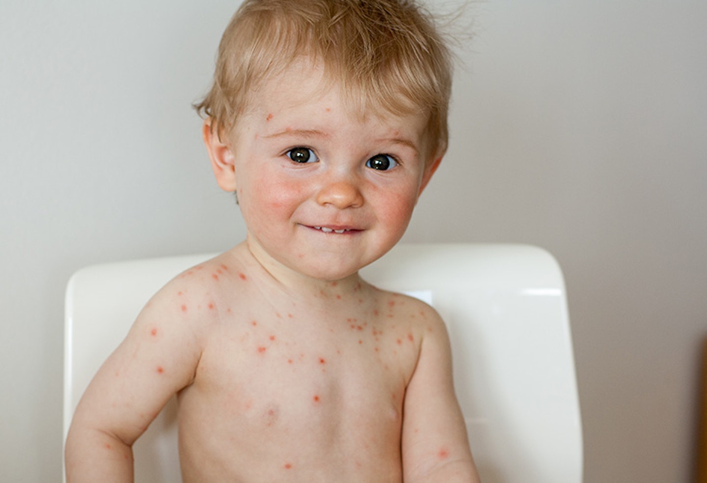 chickenpox