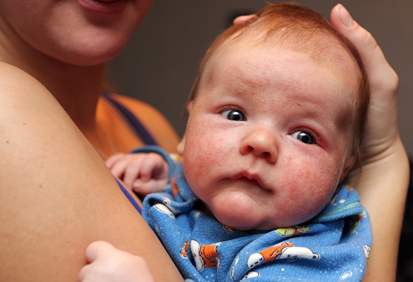 baby with eczema