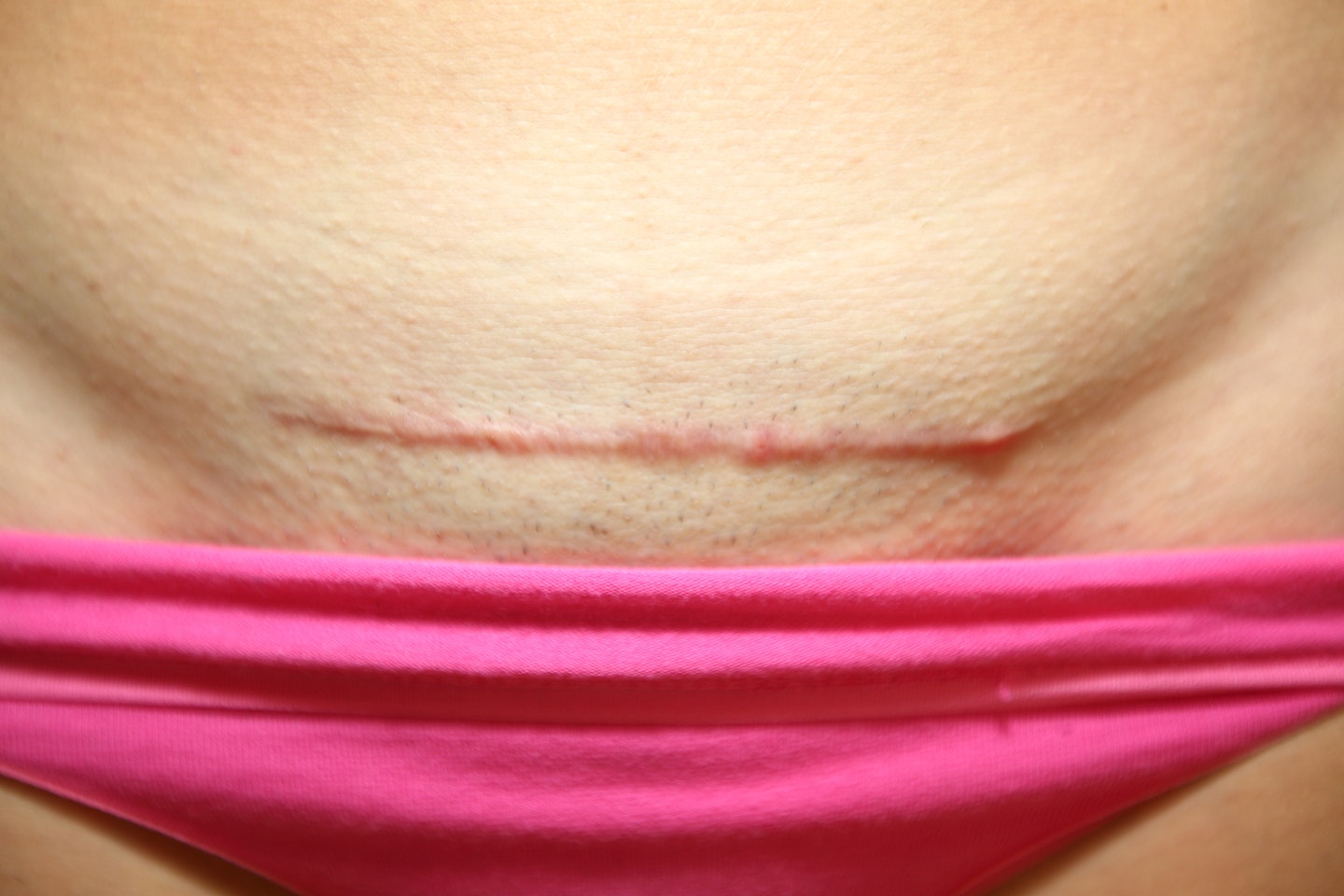 Scar on womens body