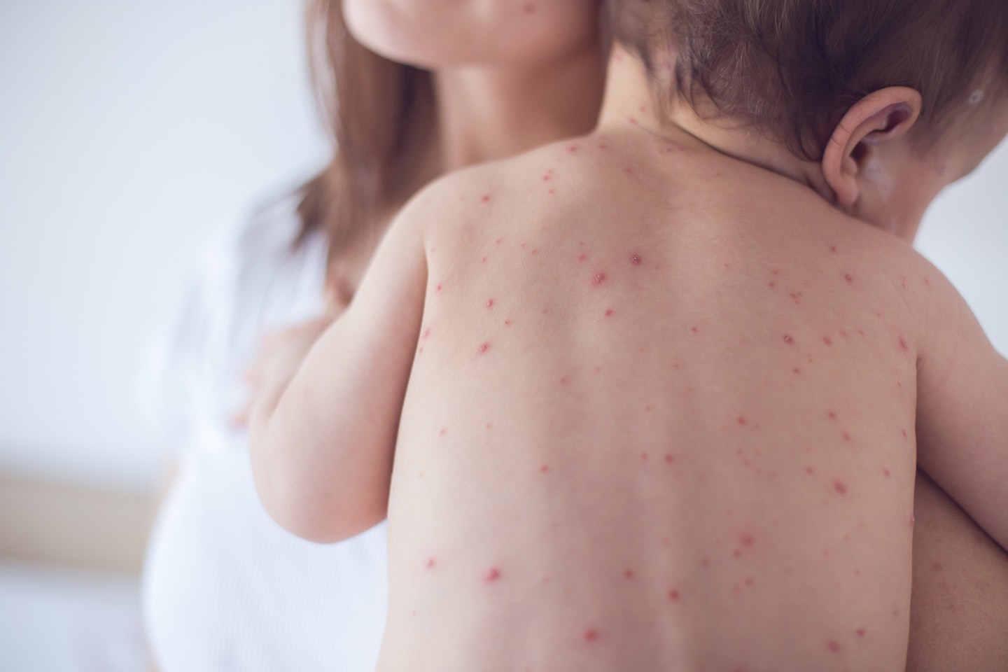 Chicken pox - Oatmeal bath