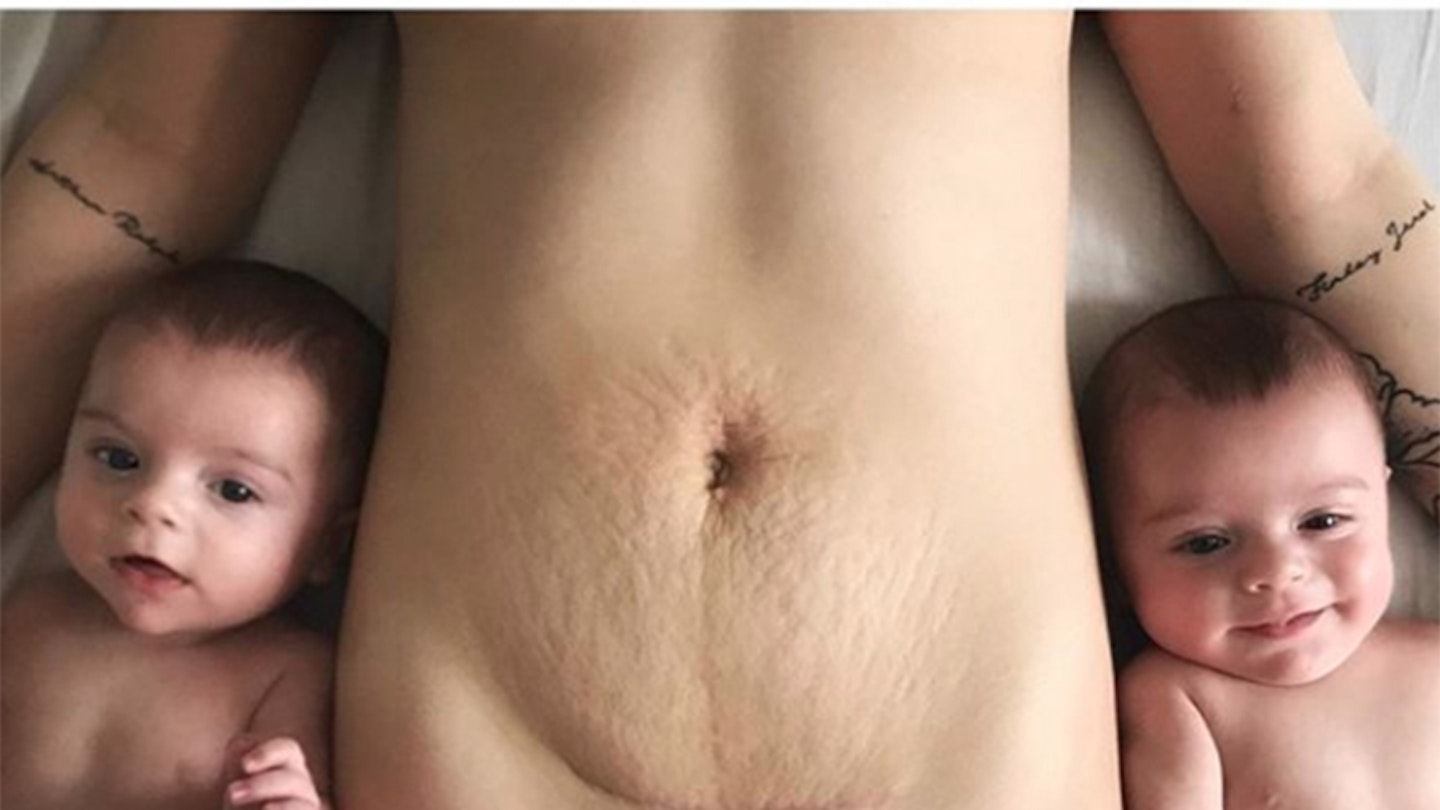 Post pregnancy body