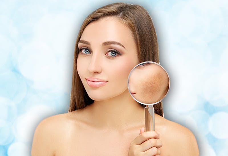 Melasma 101 everything you need to know about the pregnancy face mask