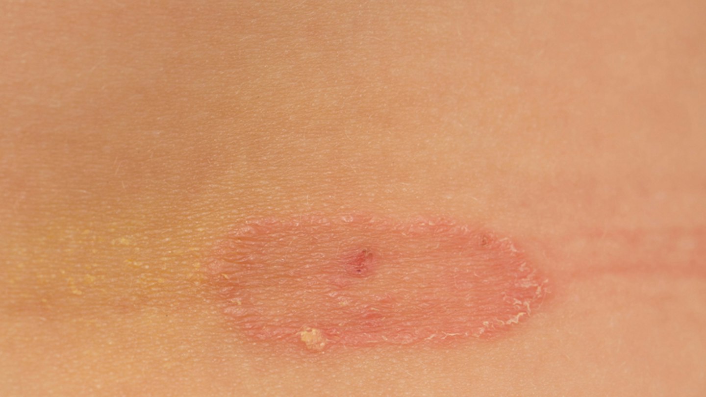 Ringworm Rash Child Ringworm in Kids: Symptoms, Treatment & Prevention Tips