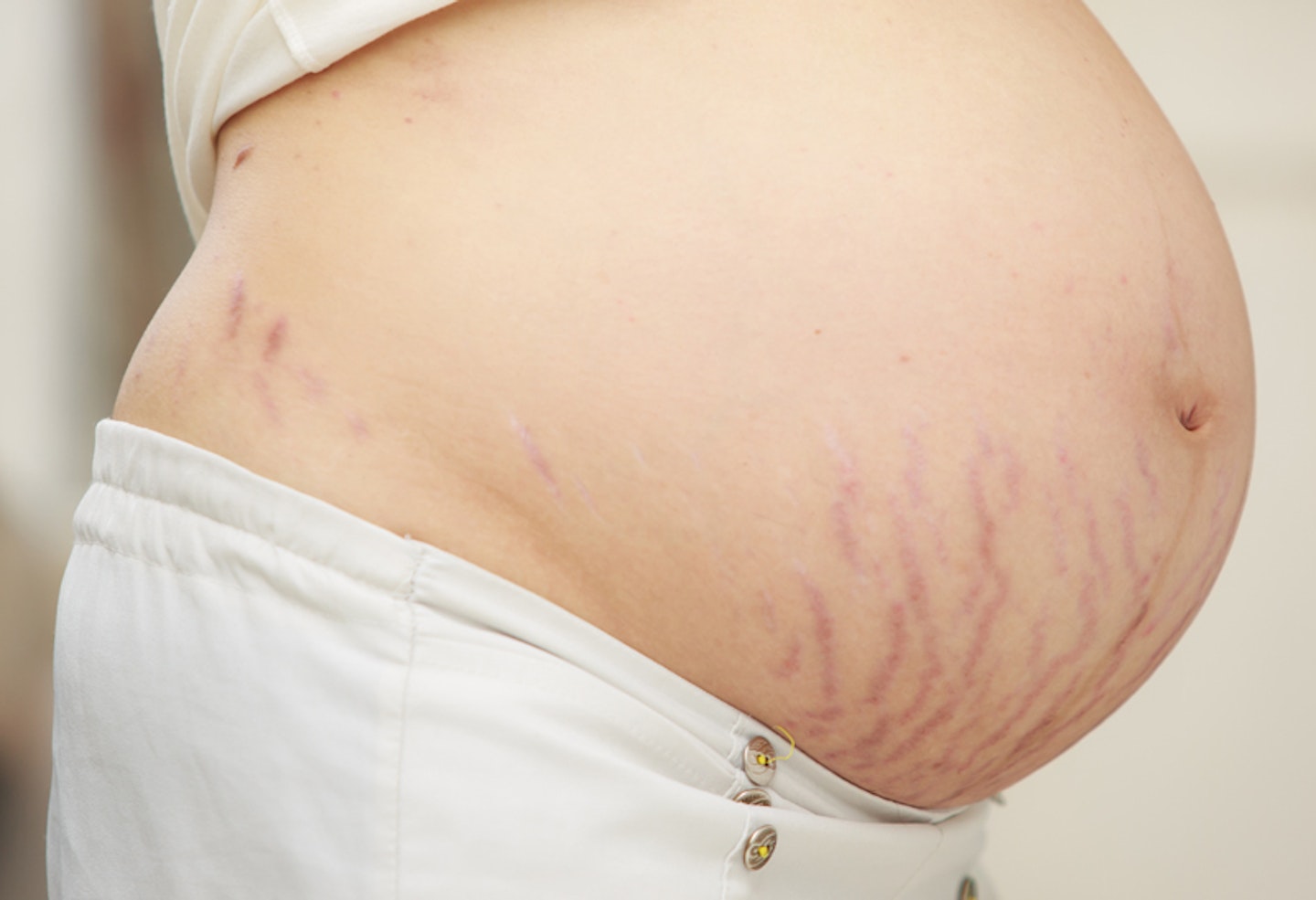 20 Weeks Pregnant  Stretch Marks, Ultrasound And Infections