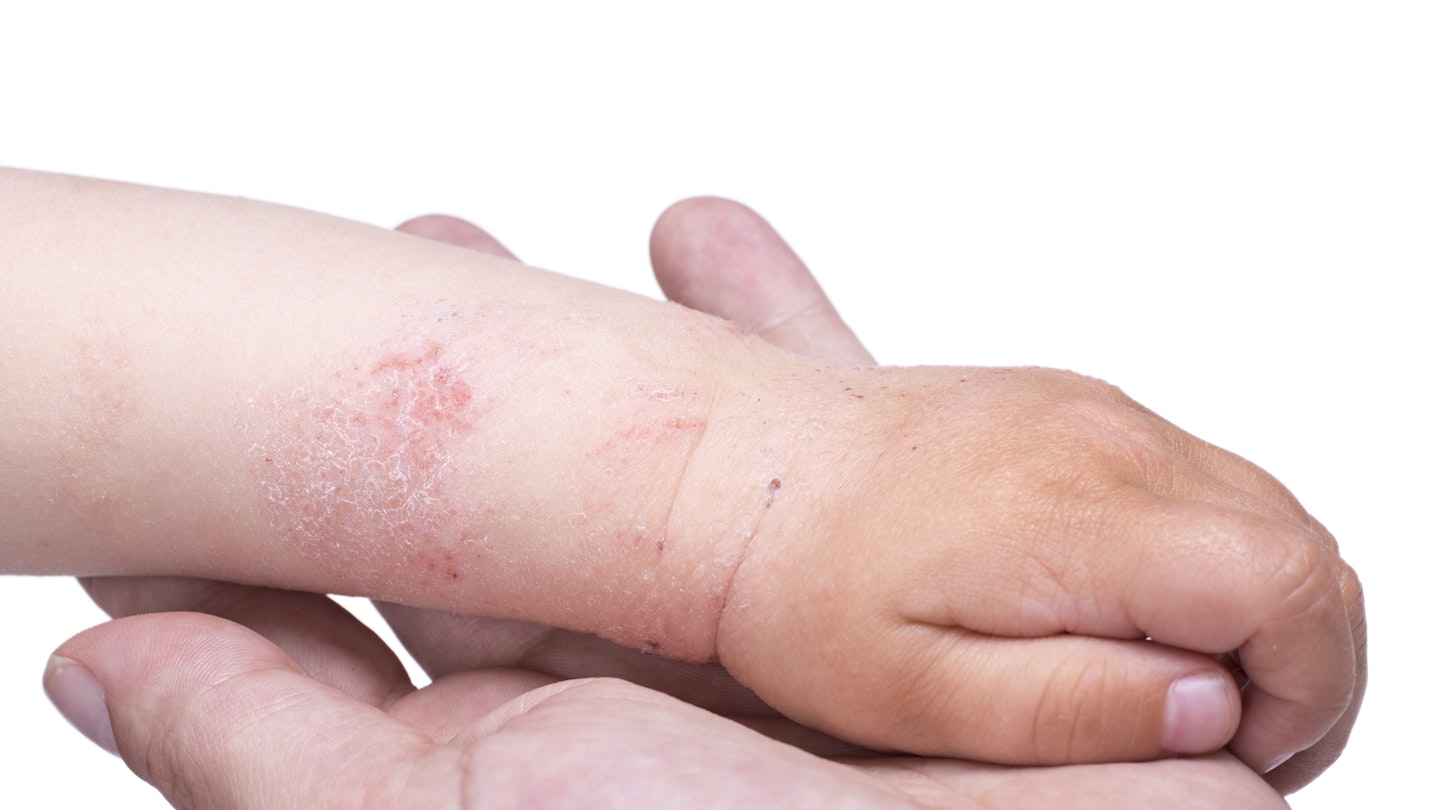 Top tips for eczema-prone skin