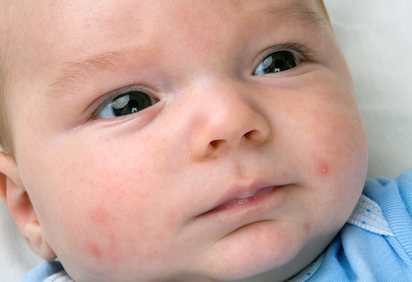 allergy rashes in children