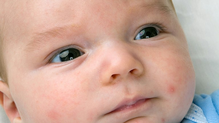 Baby Rashing Understanding Baby Rashes: Identifying and Finding Causes