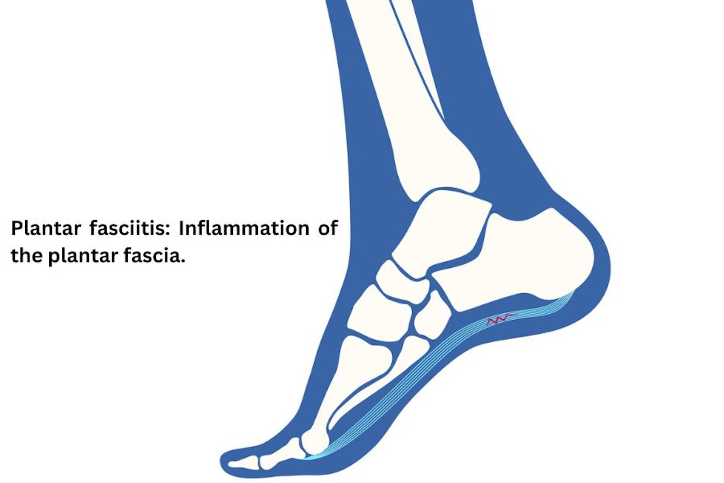 plantar fasciitis