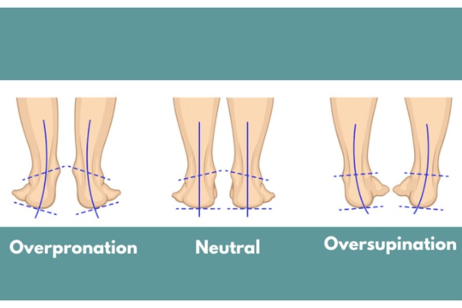 A diagram showing the differences between overpronation and underpronation, as well as normal pronation