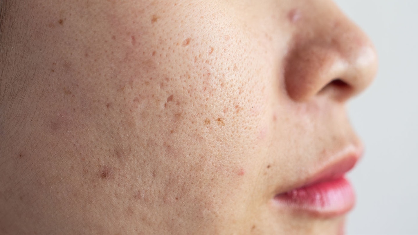 woman with acne scar