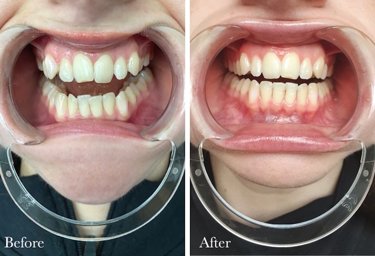 Smile Direct Club Non Disclosure Agreement Smile Direct Club review