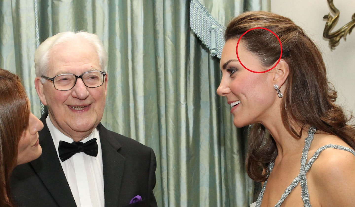 Kate middleton hair scar