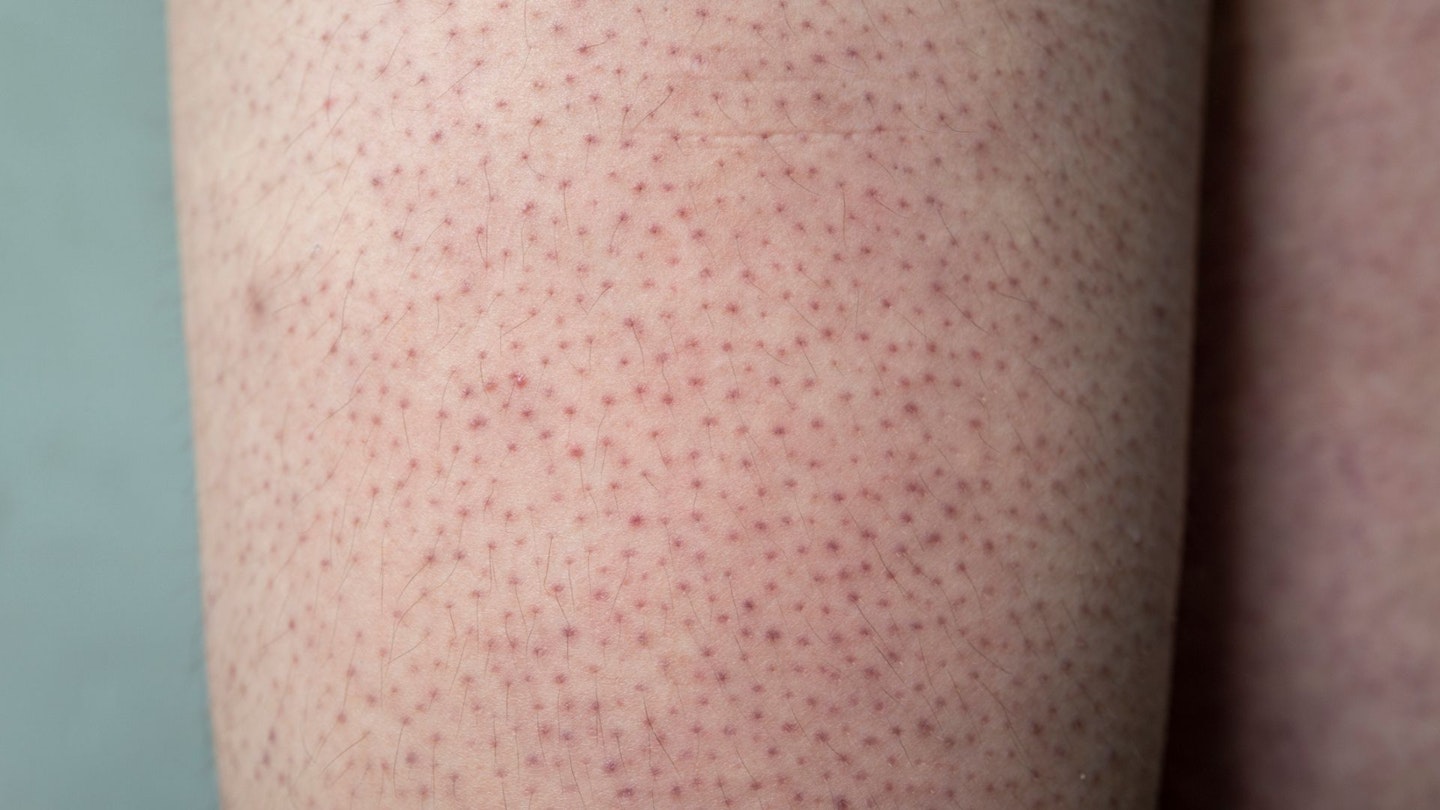 Close up of Keratosis Pilaris symptoms