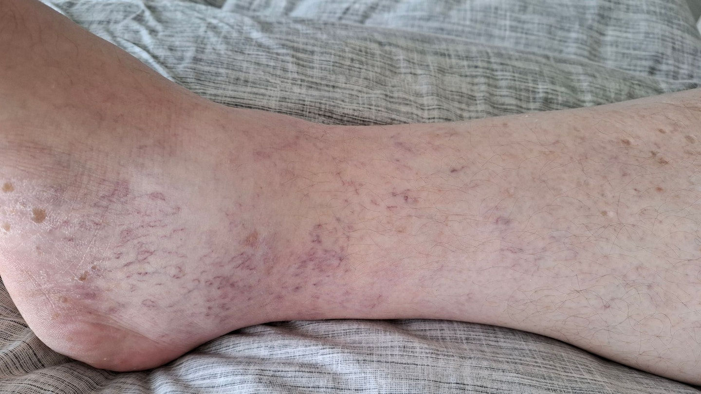 Example of ankle oedema