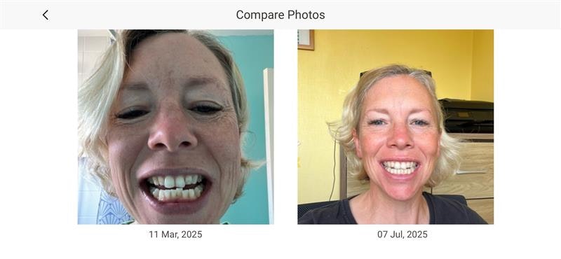 Invisalign comparison March to July