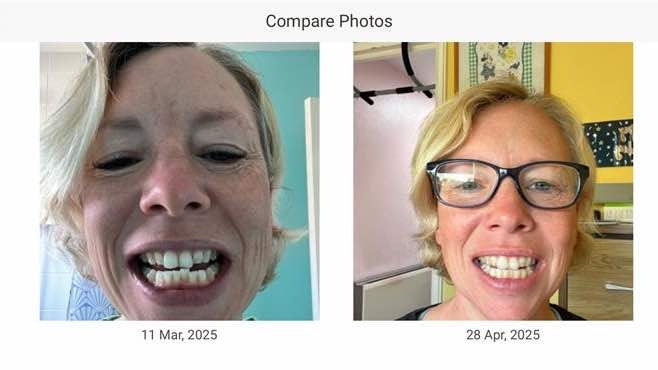 Left picture from March 2025 at the start of Invisalign, Right picture from end of April 2025 mid-way through Invisalign
