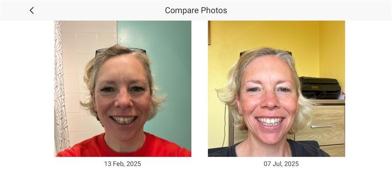 Invisalign comparison from February to July