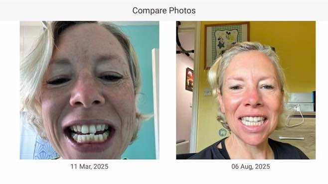 Invisalign progress photos