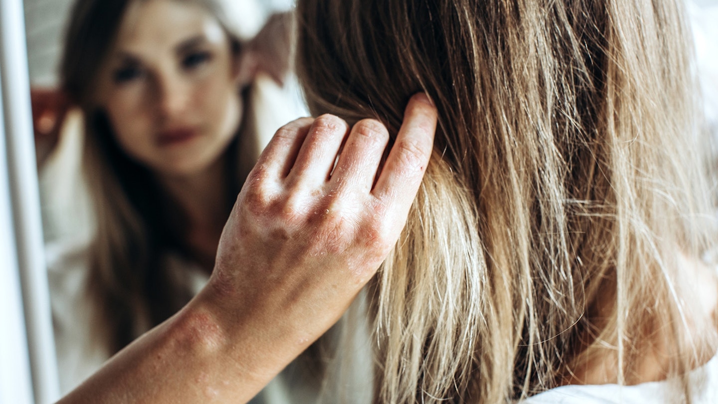Psoriasis, a skin disease in a young woman, a hair problem
