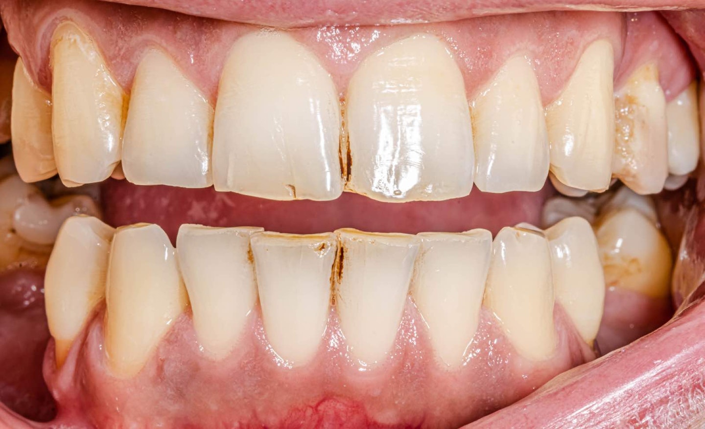 Teeth with brown marks