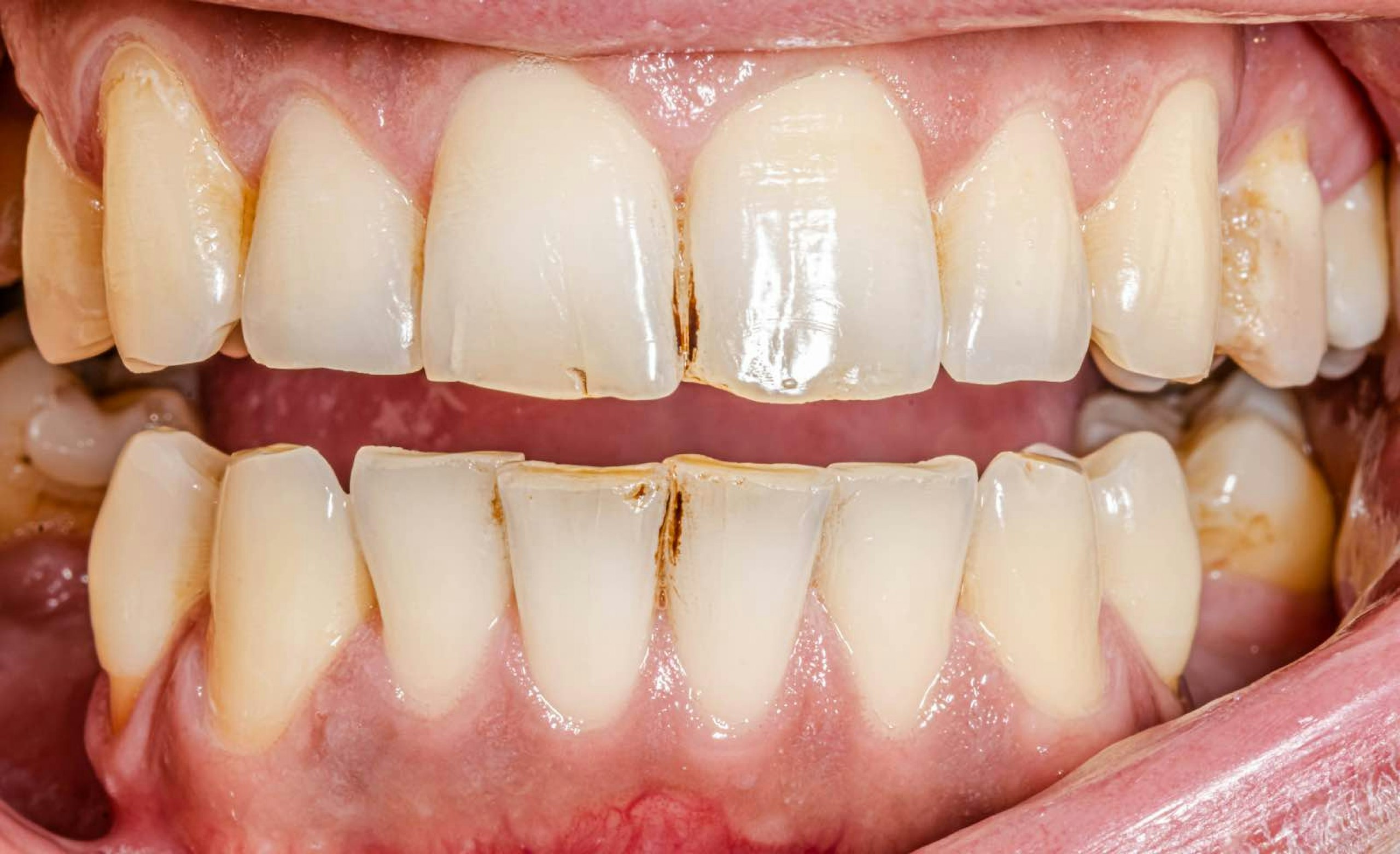 Teeth with brown marks