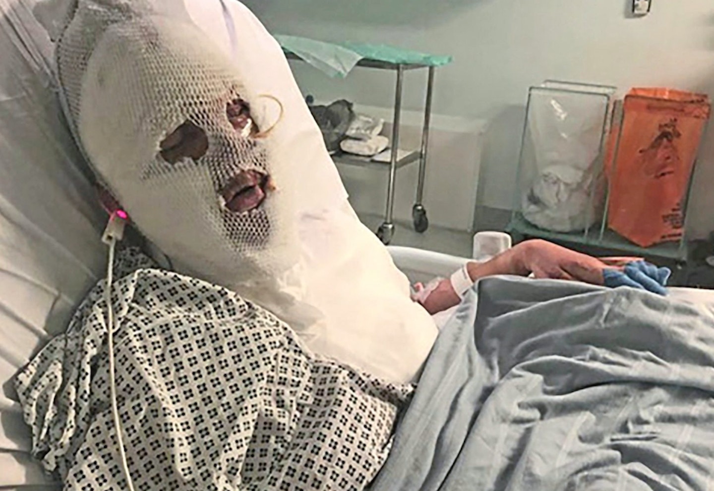 Burns survivor April Charlesworth in hospital
