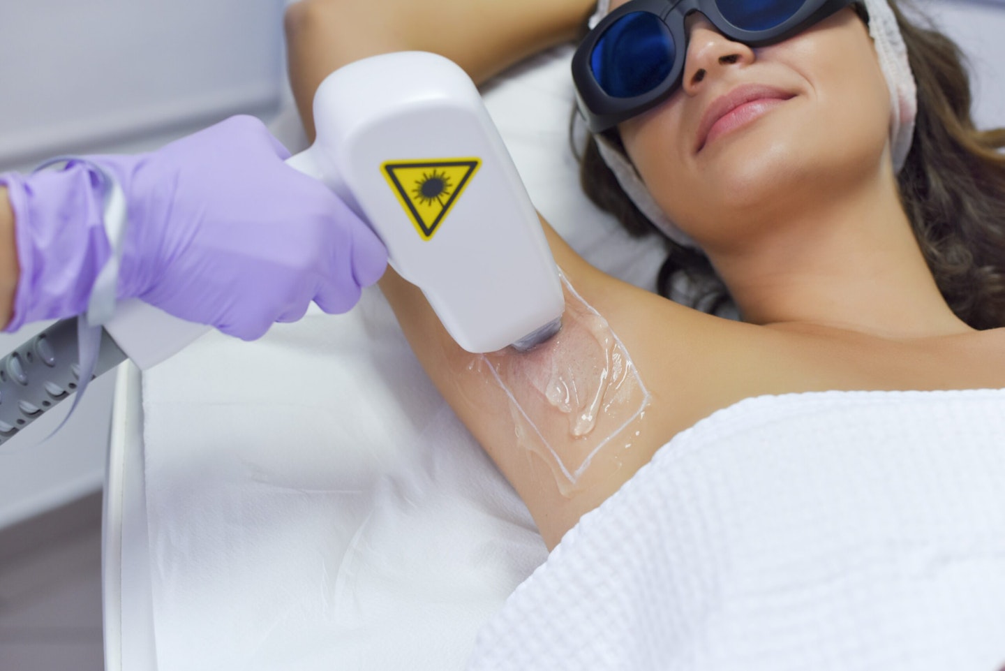 laser hair removal