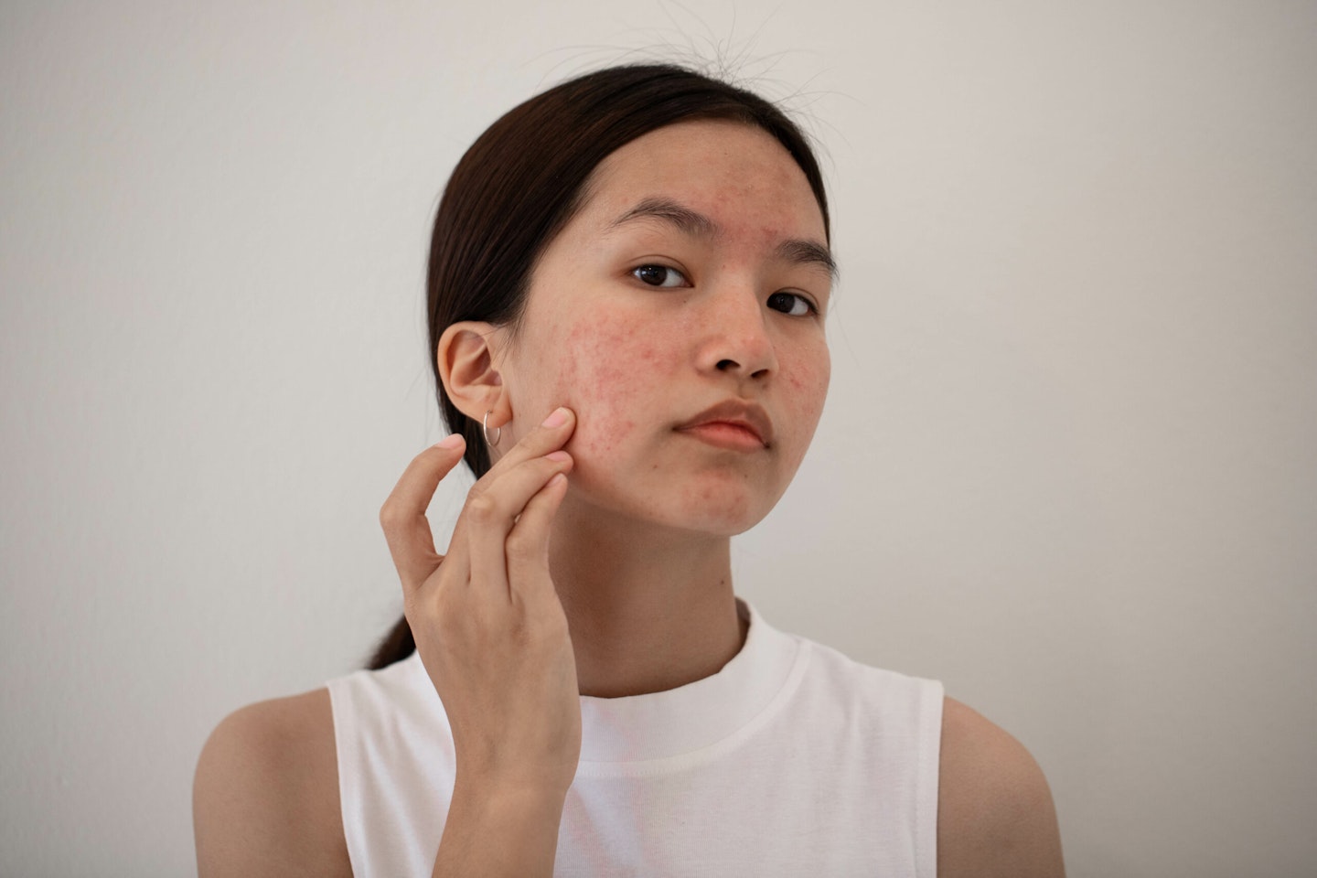 Woman looking at acne on face