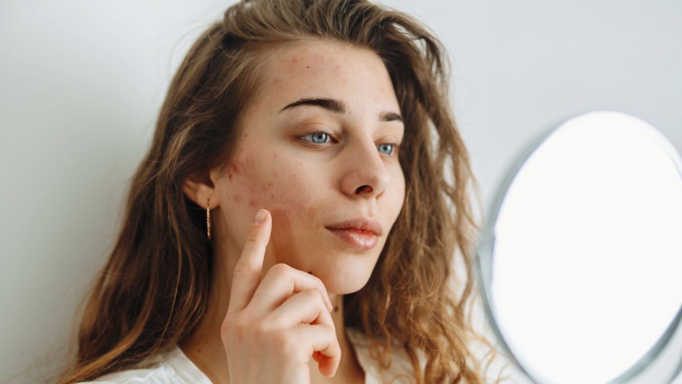 How to get rid of acne scars for good, according to an expert