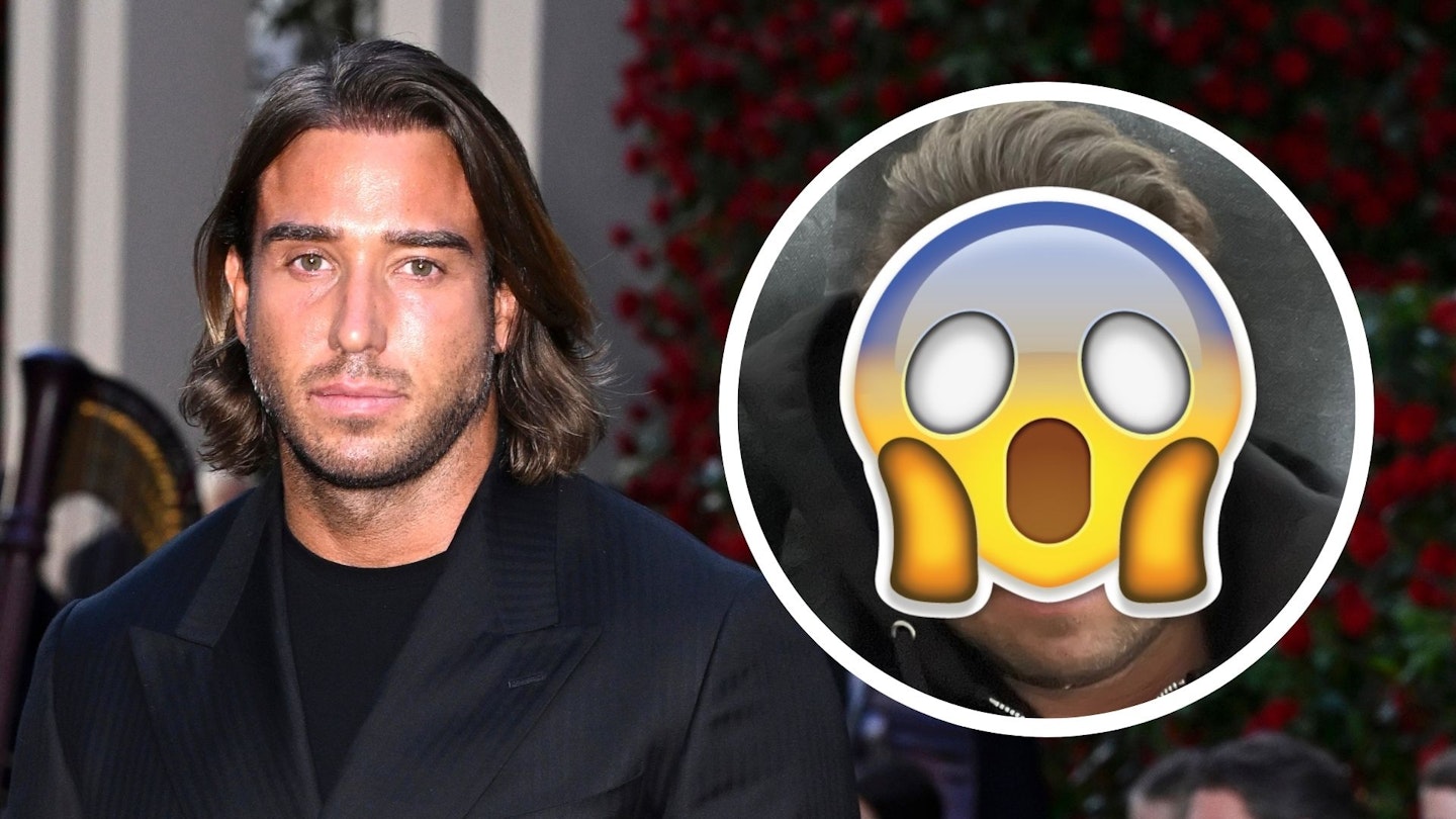 TOWIE’s James Lock looks ‘like different person’ following surgery