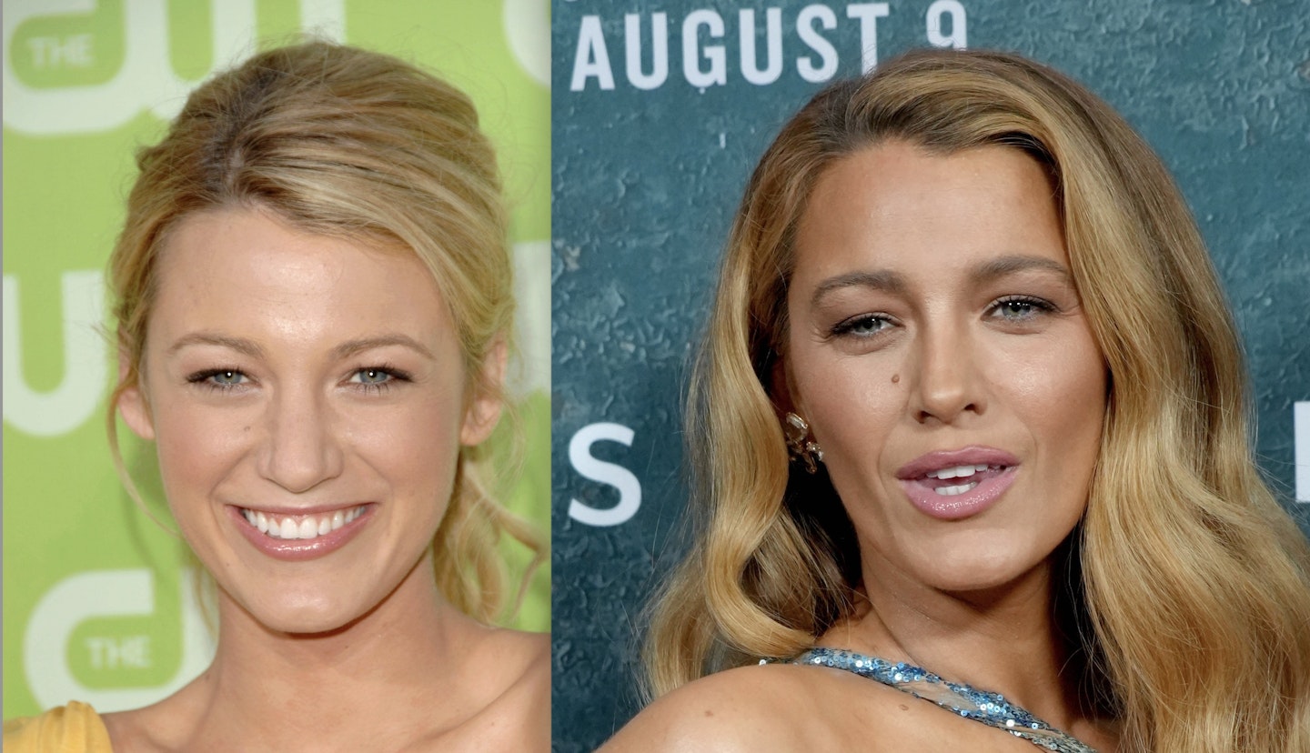 blake lively before and after