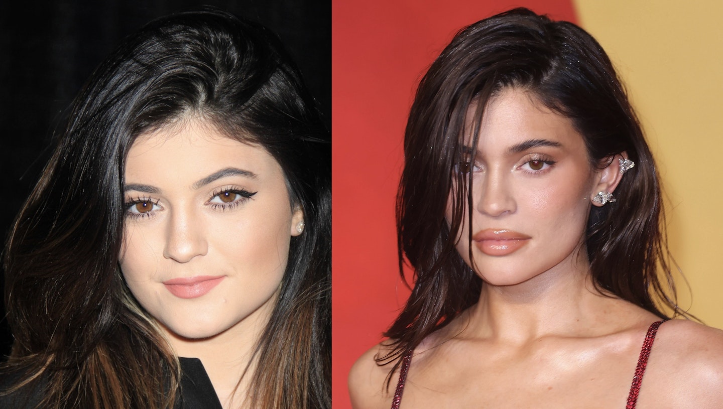 kylie jenner before and after