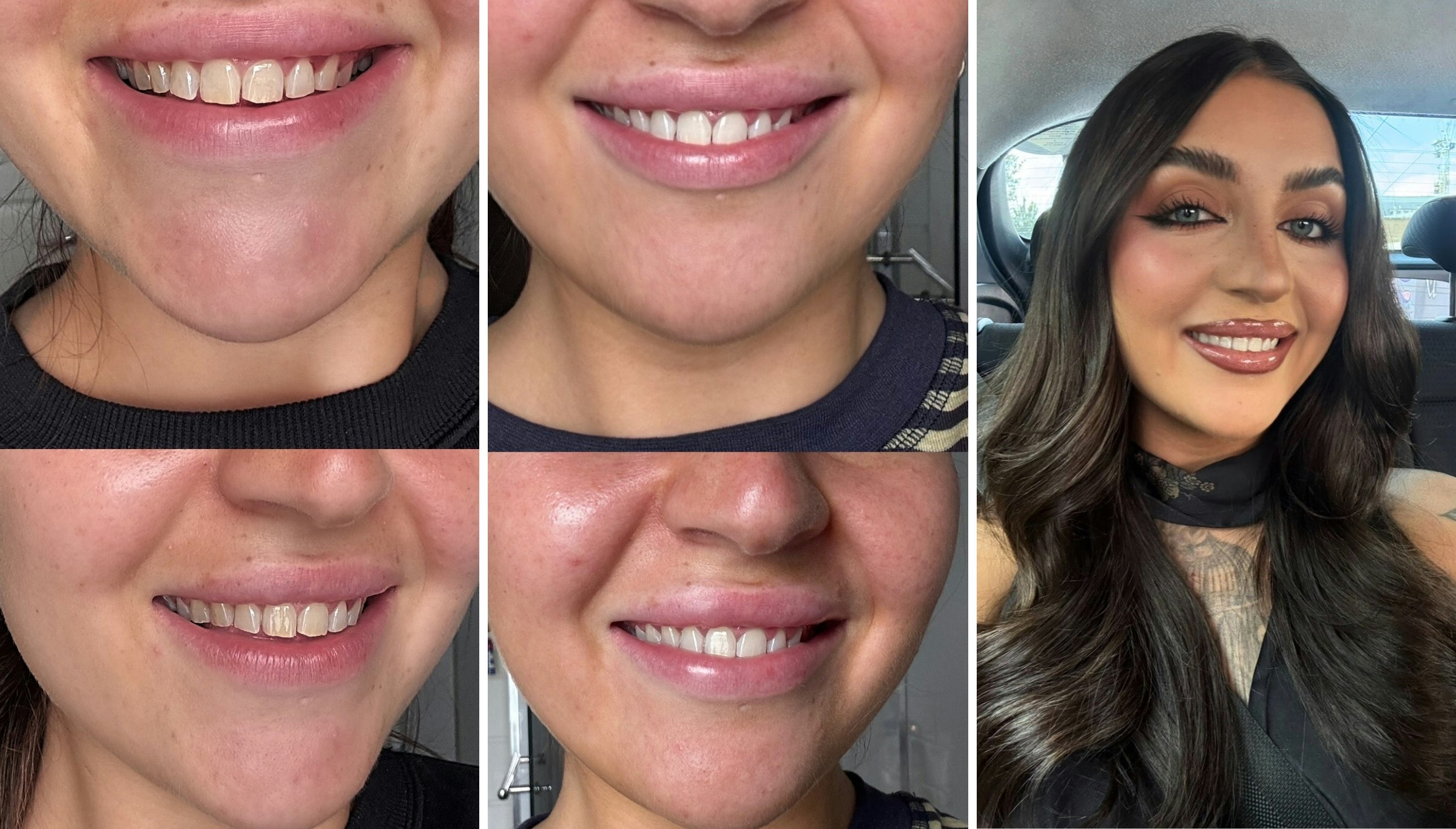 Emma Hawkins teeth whitening