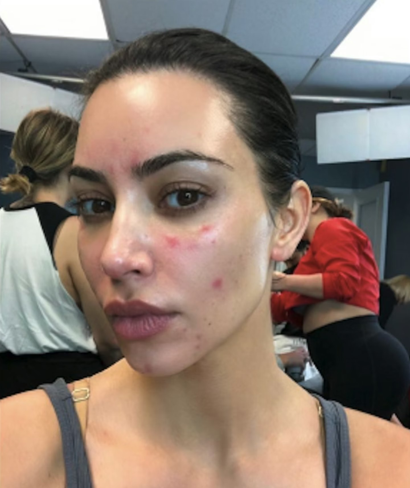 Kim Kardashian psoriasis