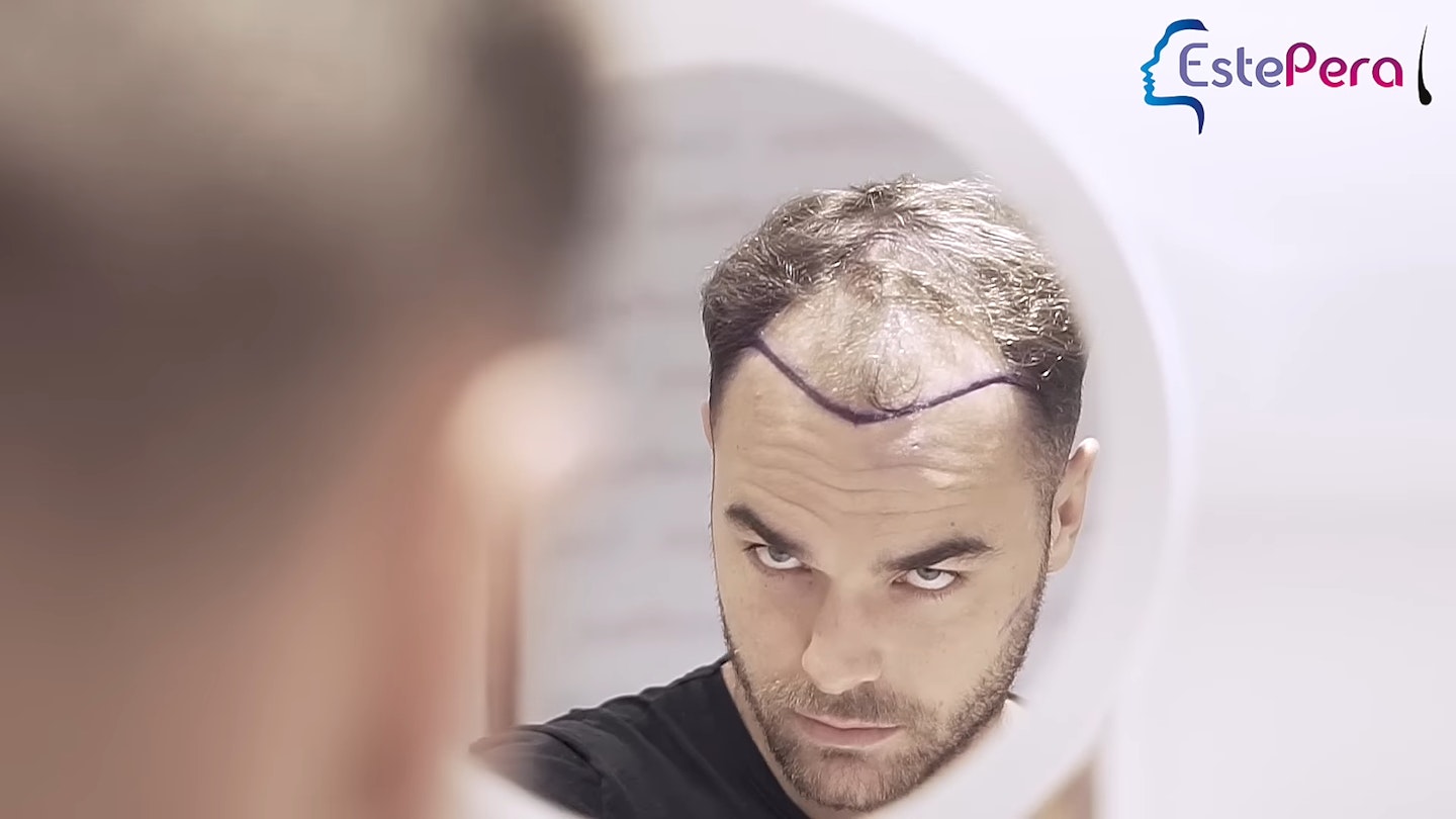 Harry Cooksley's hair transplant