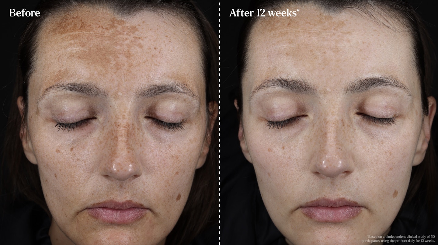 Clinical trials for the serum found a reduction in brown spots by up to 17% after 4 weeks, and up to 24% after 8 weeks