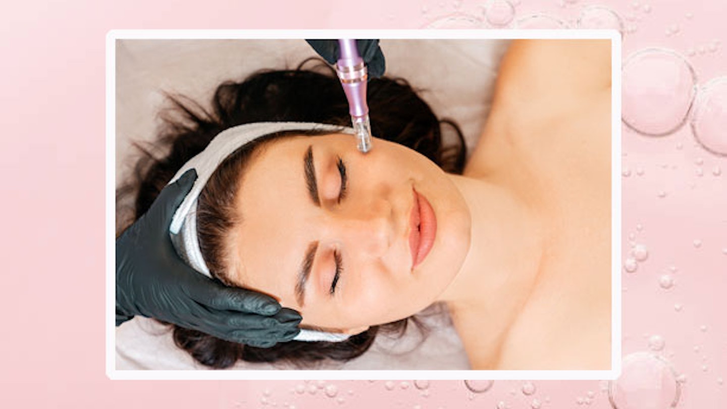 what-is-microneedling
