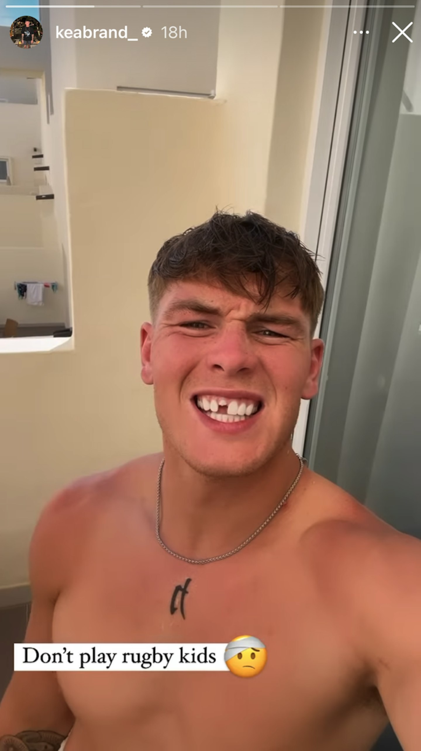 keanan brand love island missing tooth