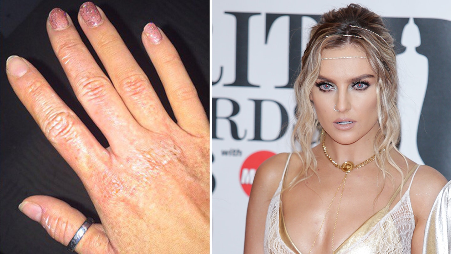 perrie edwards burns