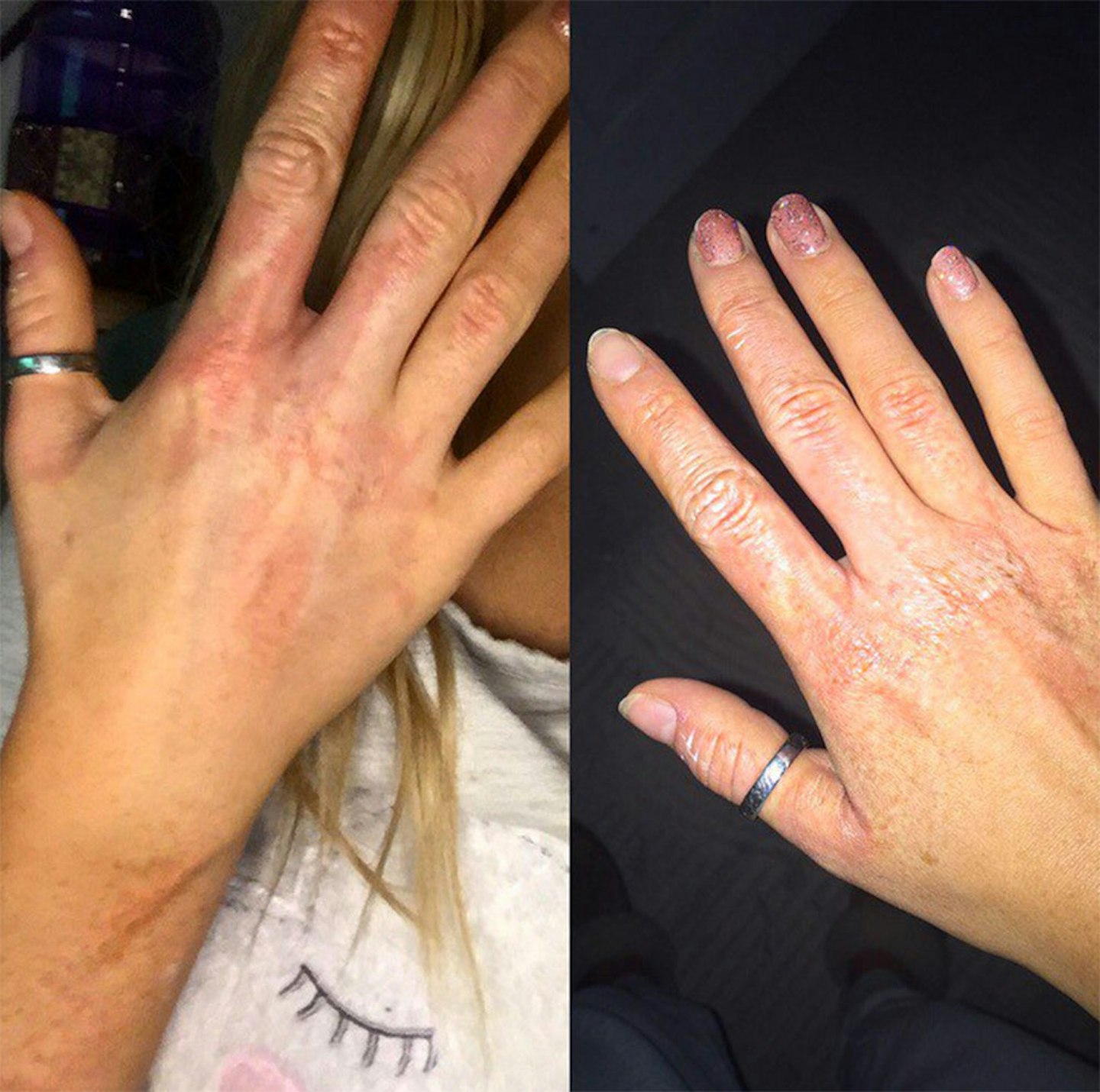 perrie edwards burnt hand