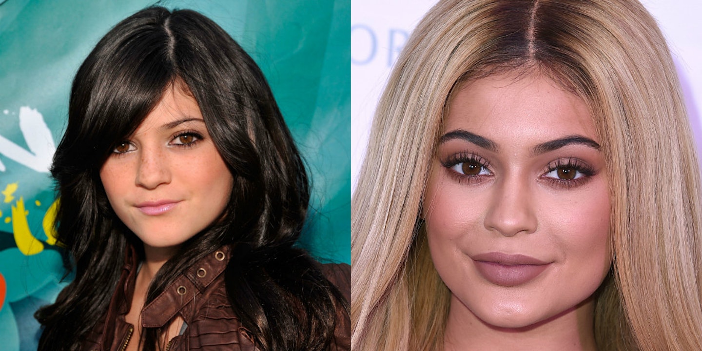 kylie jenner lips before and after fillers