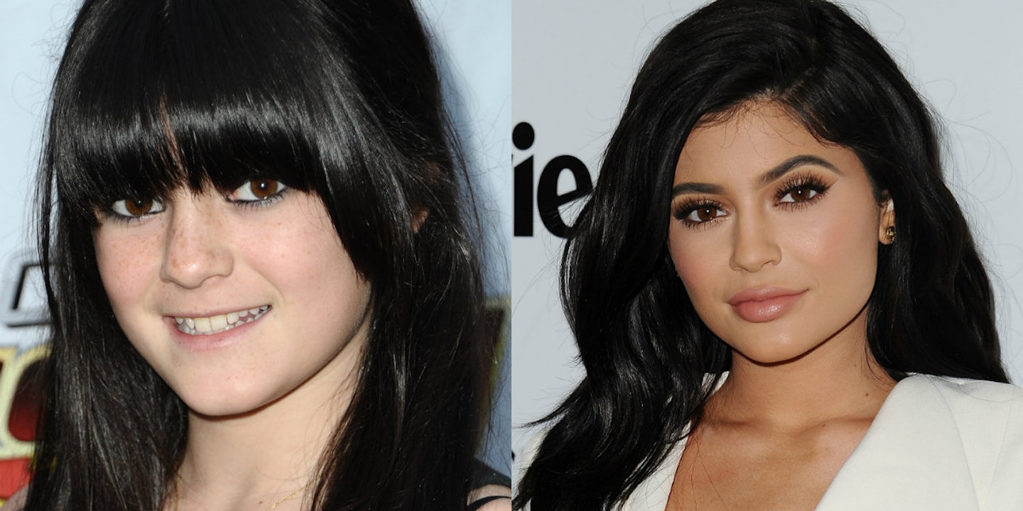 kylie jenner plastic surgery collage