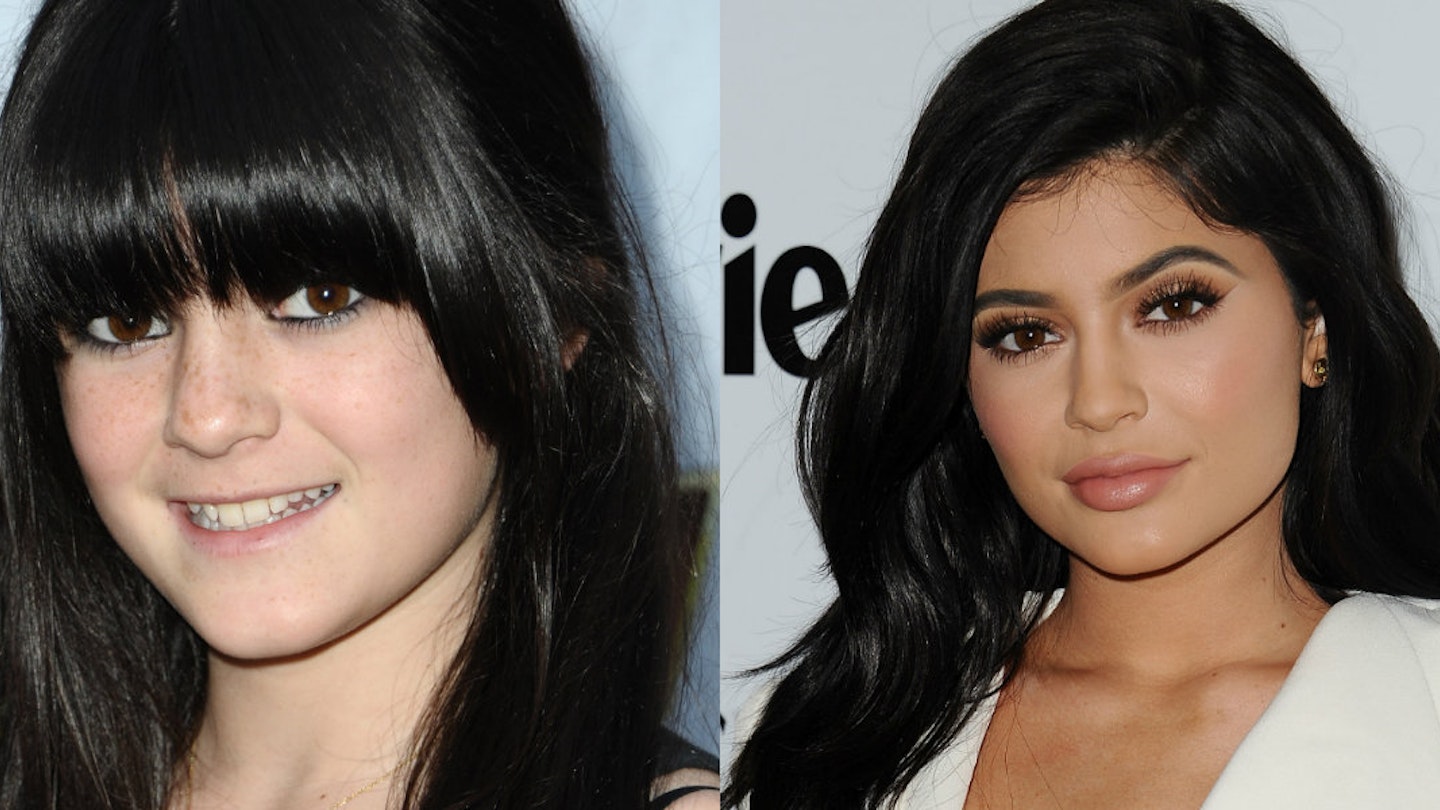 kylie jenner plastic surgery collage