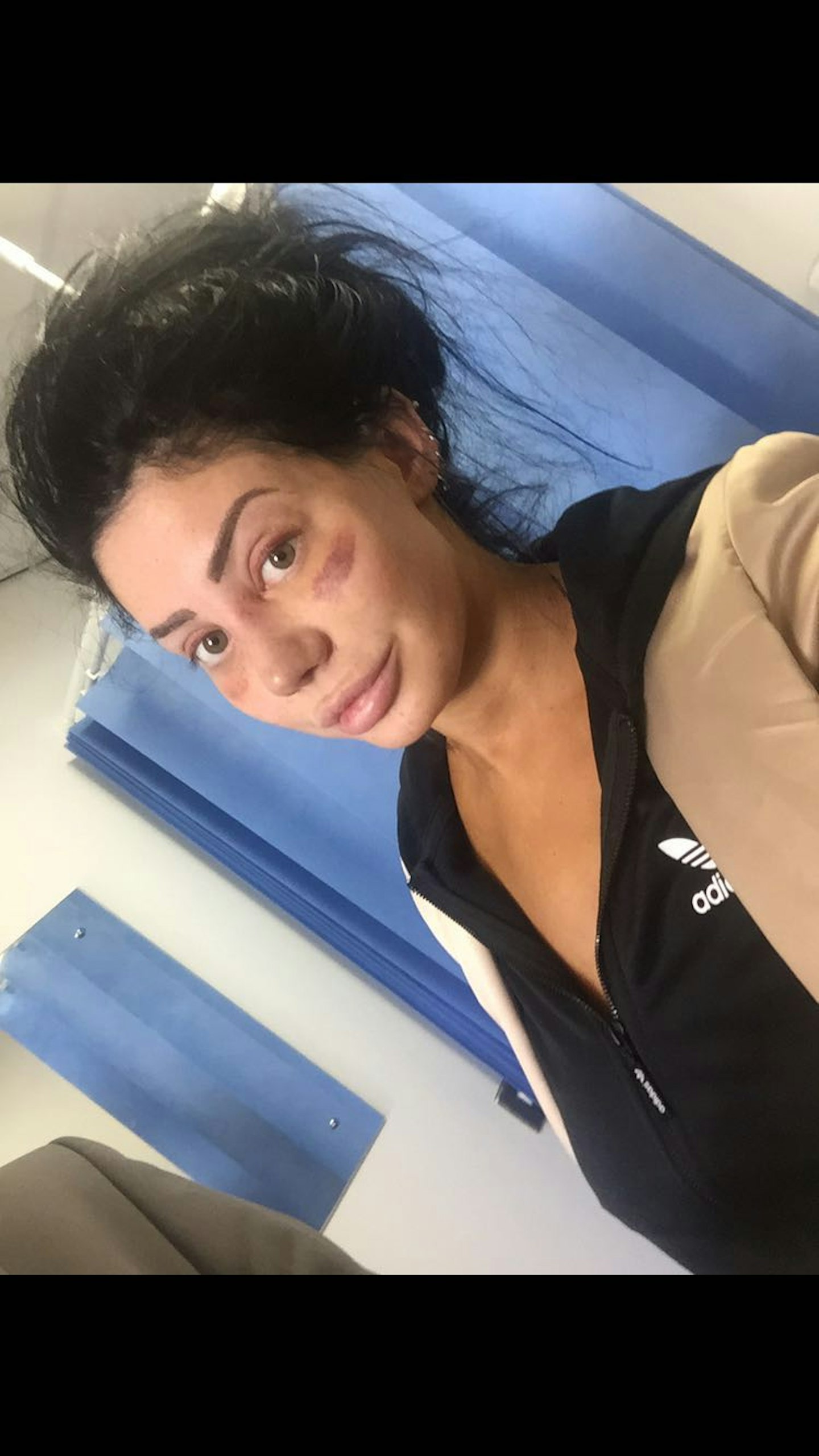 chloe ferry geordie shore plastic surgery nose job before and after