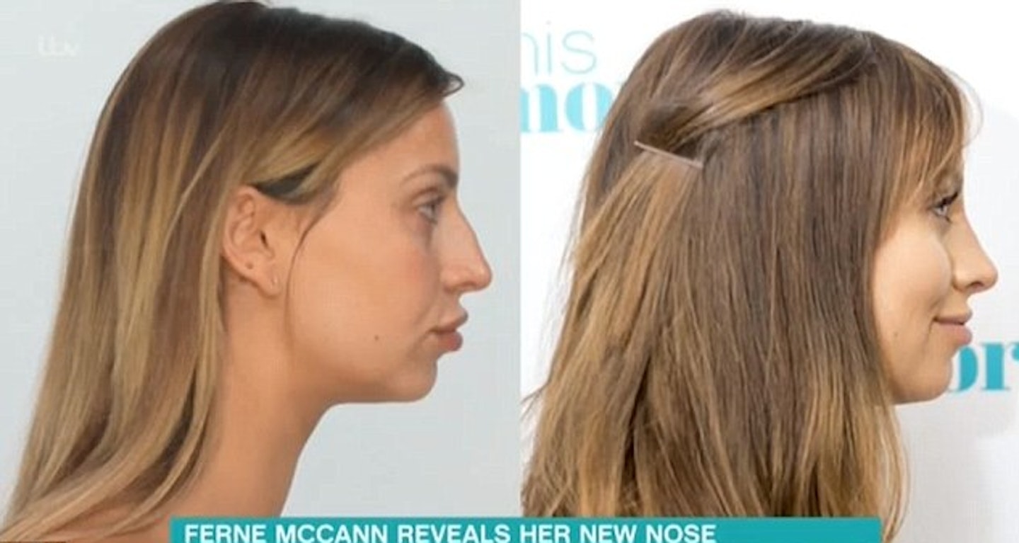 Ferne McCann nose job