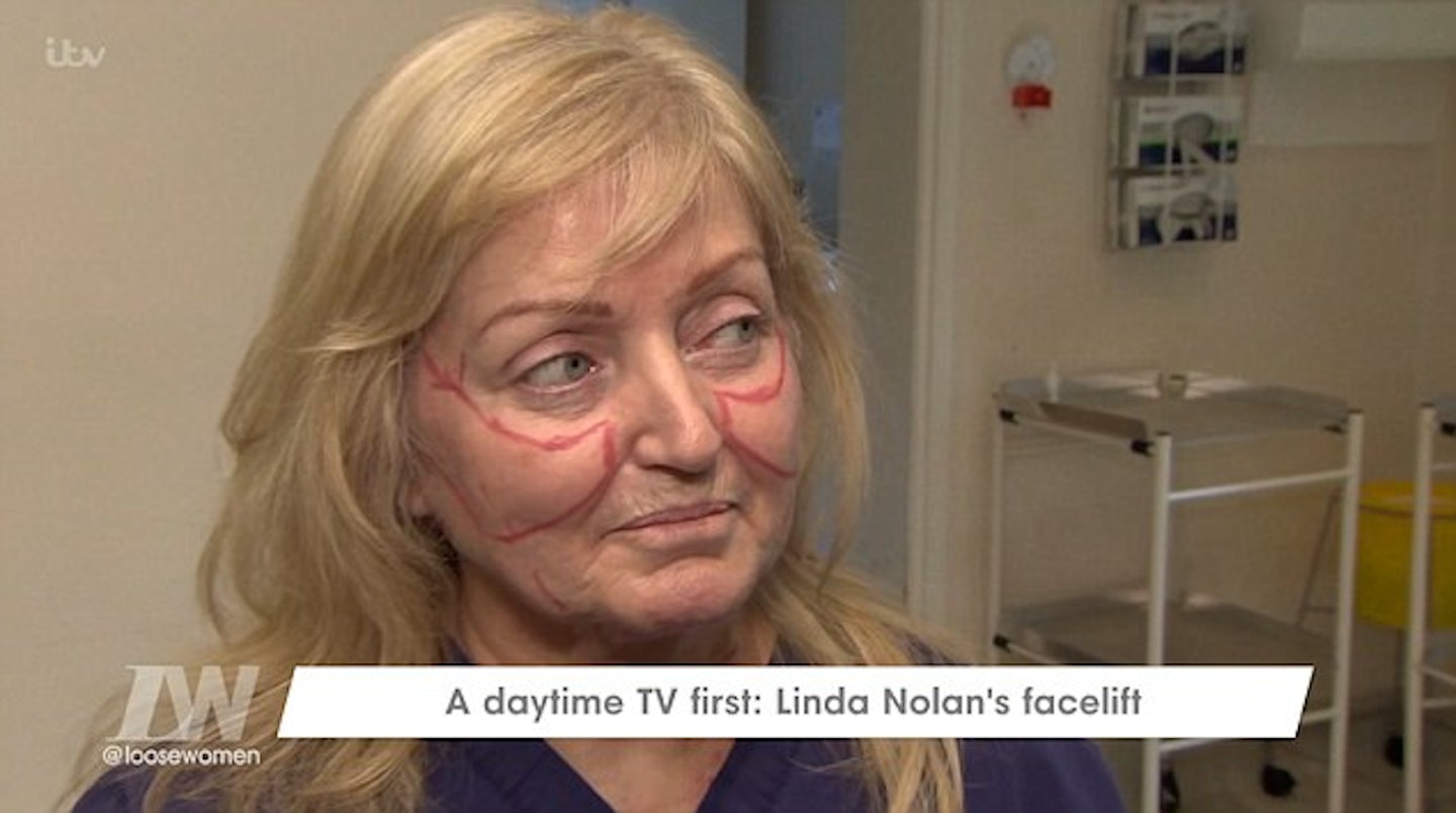 Linda Nolan facelift