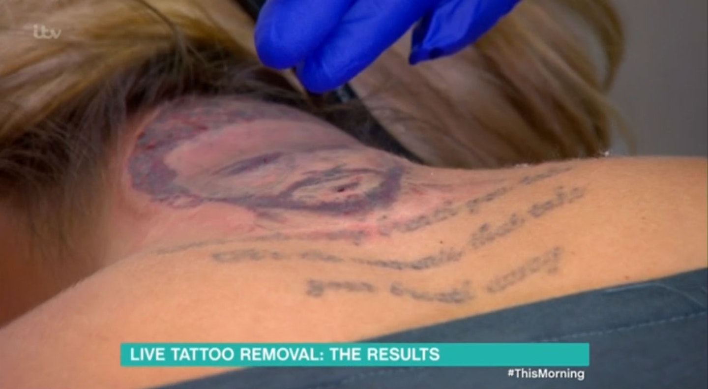 Holly Hagan tattoo removal
