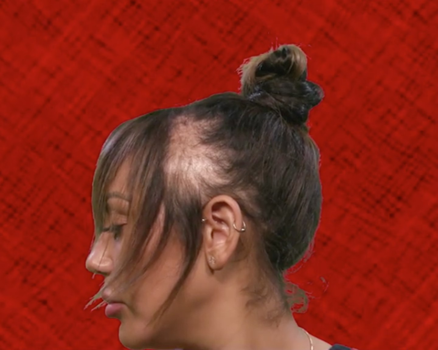 Sophie Kasaei alopecia